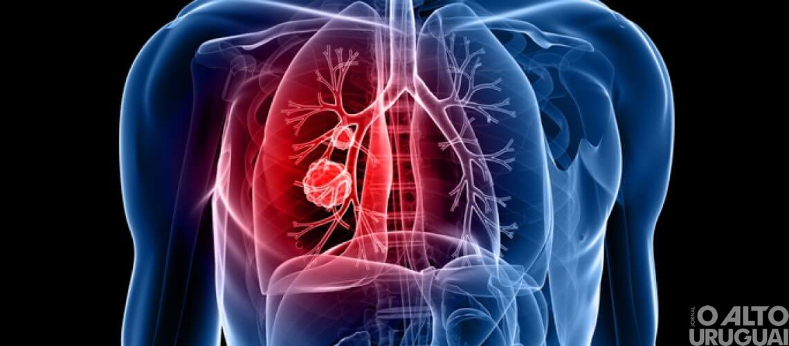 Nódulo pulmonar deve ser avaliado por um especialista