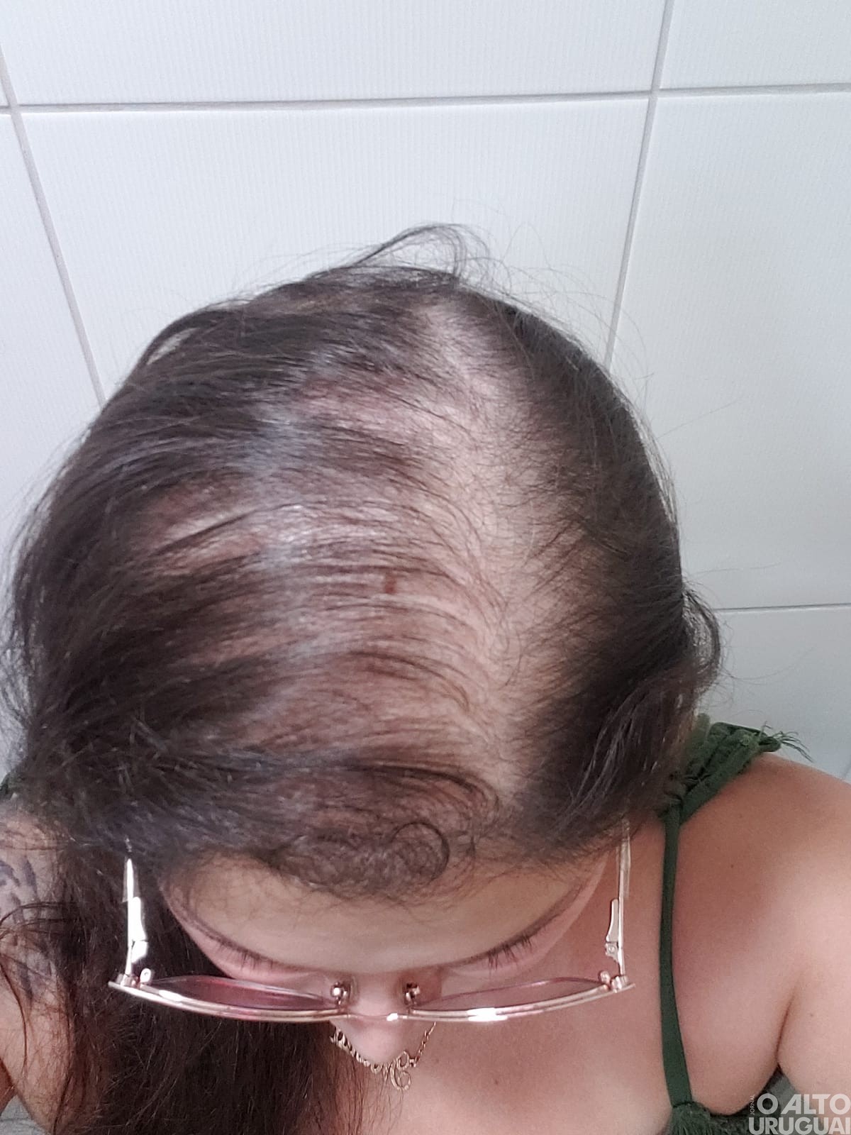 Frederiquense busca recursos para custear tratamento 