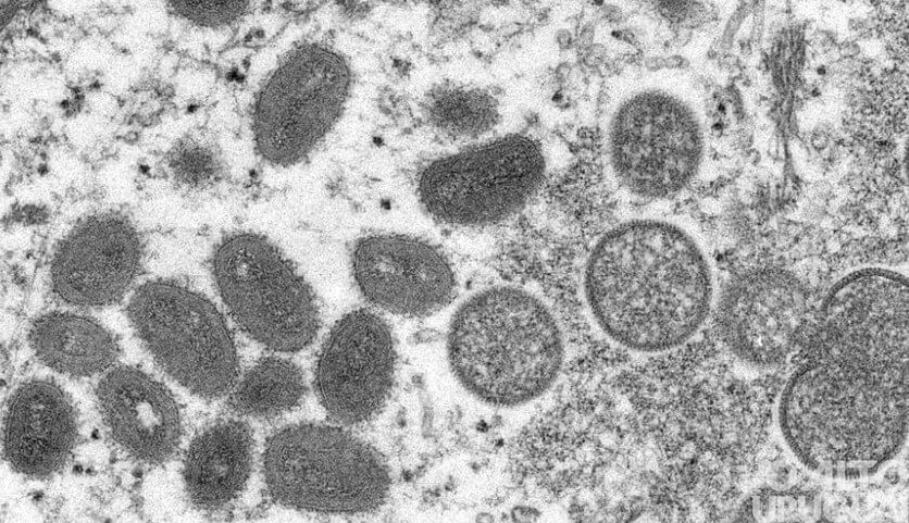 Casos de varíola dos macacos chegam a 76 em todo o país