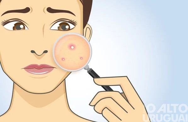 Acne: guia completo de cuidados e tratamentos