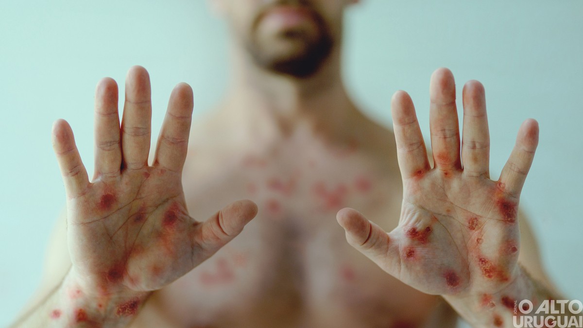 Varíola dos macacos: planos de saúde ainda não oferecem cobertura para exames